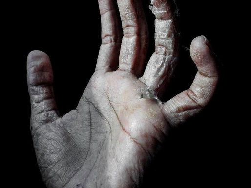 An Introductory Guide to Atopic Dermatitis