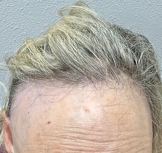 Frontal fibrosis alopecia