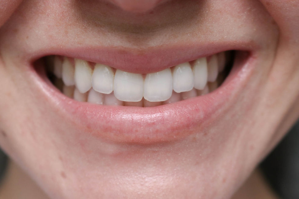 teeth whitening kit