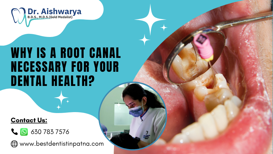 Why is a Root Canal Necessary for Your Dental Health?