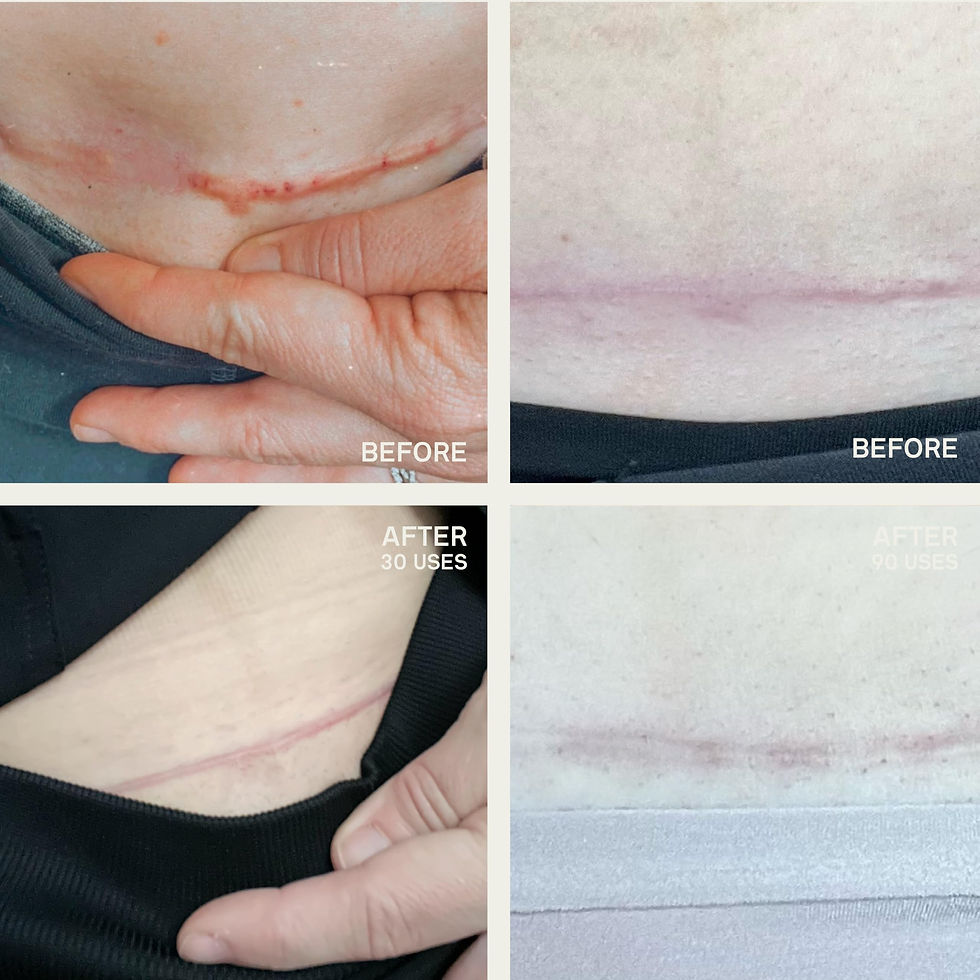 Thumbnail: Dermaclara C-Section Scar Patch - Stretch Prevention Pregnancy Mark Removal,