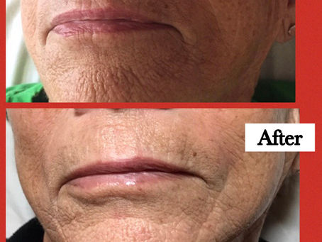 Cosmetic Acupuncture