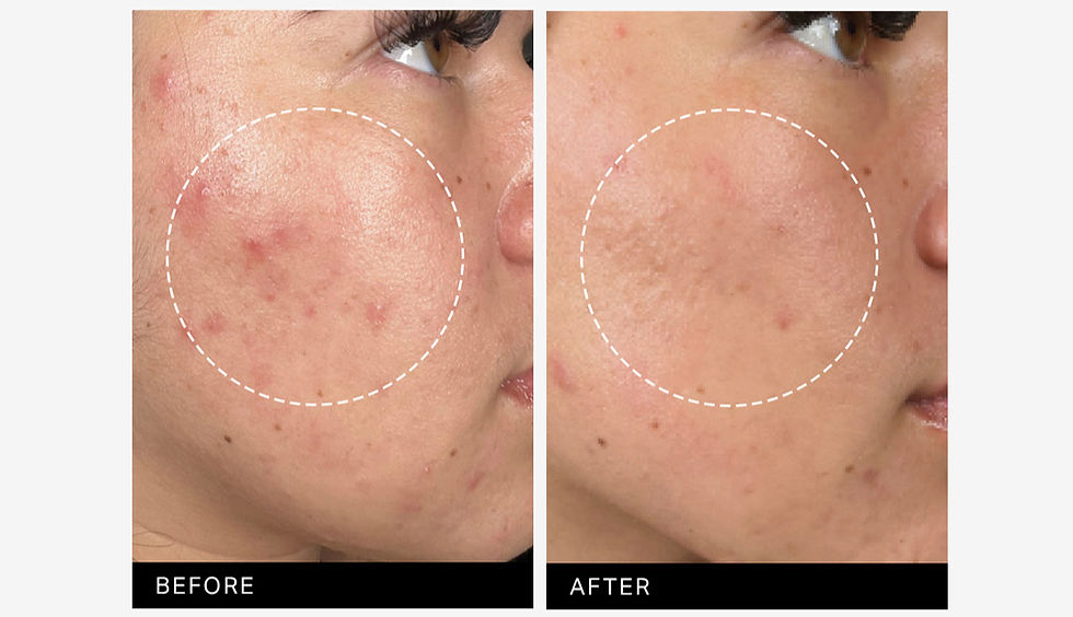Before and after Hydrafacial results for acne-prone skin at BARE Body Waxing Studio in Lake Charles.