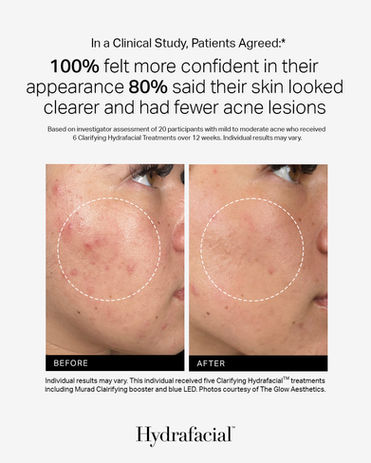 Before and after Hydrafacial results showing improved skin clarity and glow.