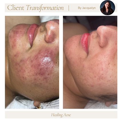 Before and after Acne Treatments results showing improved skin clarity and no more acne breakouts