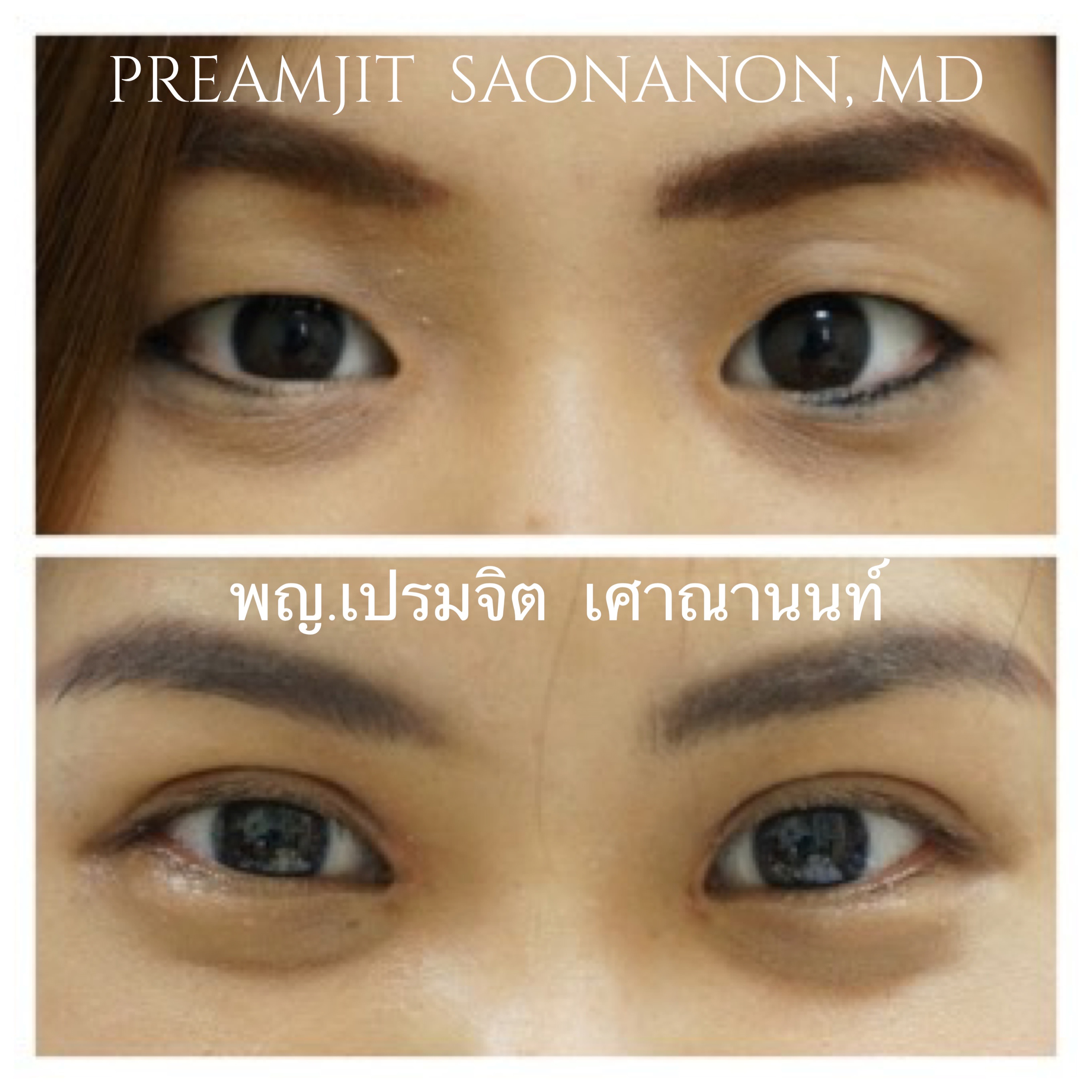 ทำตาสองชั้นเปิดหัวตา