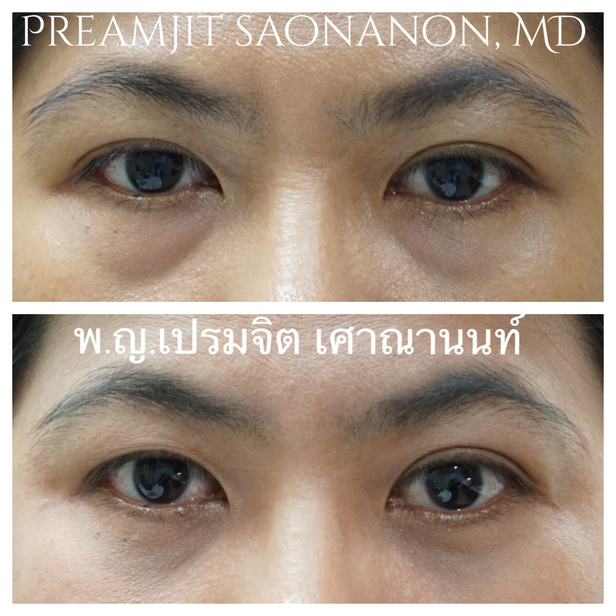 ผ่าตัดถุงใต้ตาและย้ายไขมัน