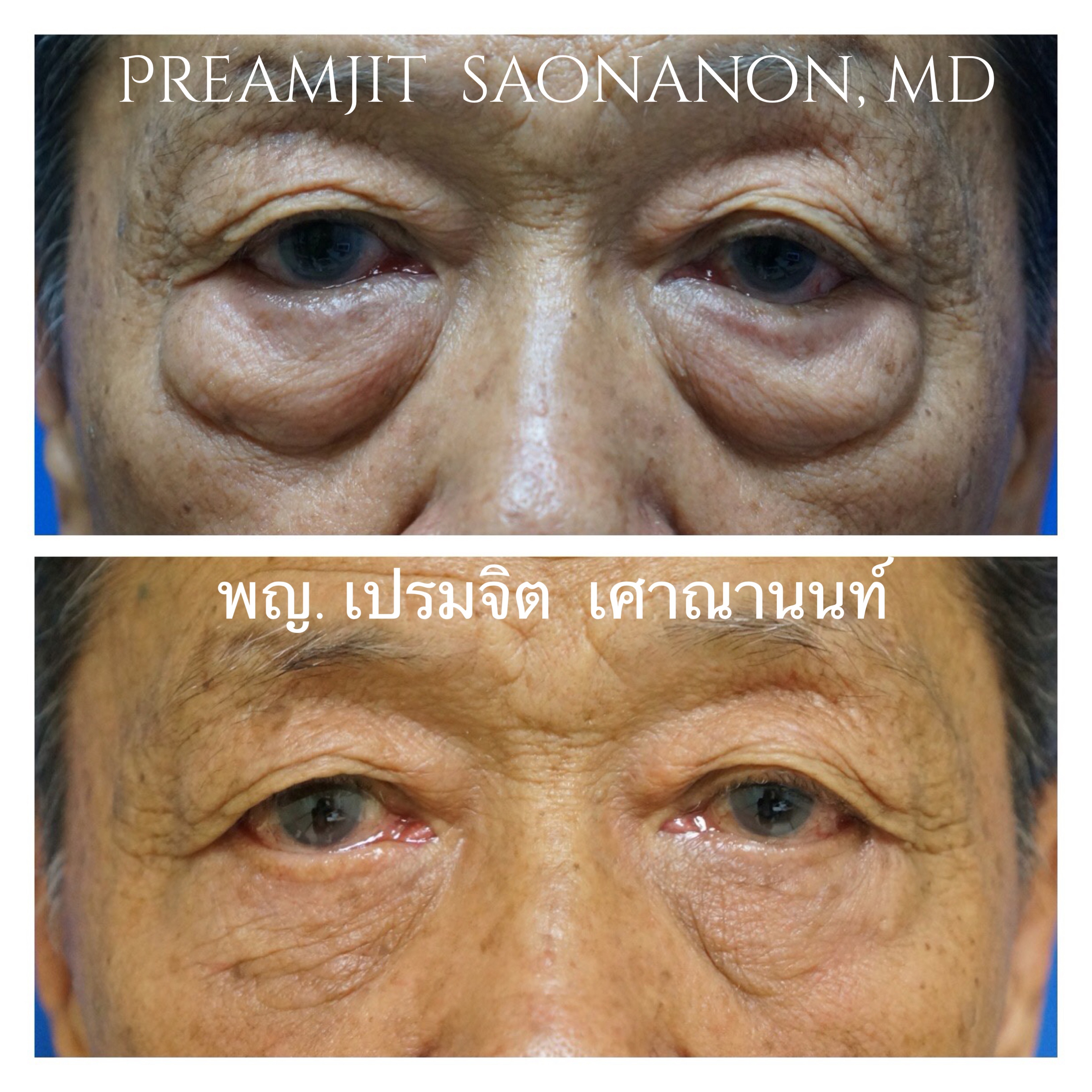ถุงใต้ตาในคนแก่