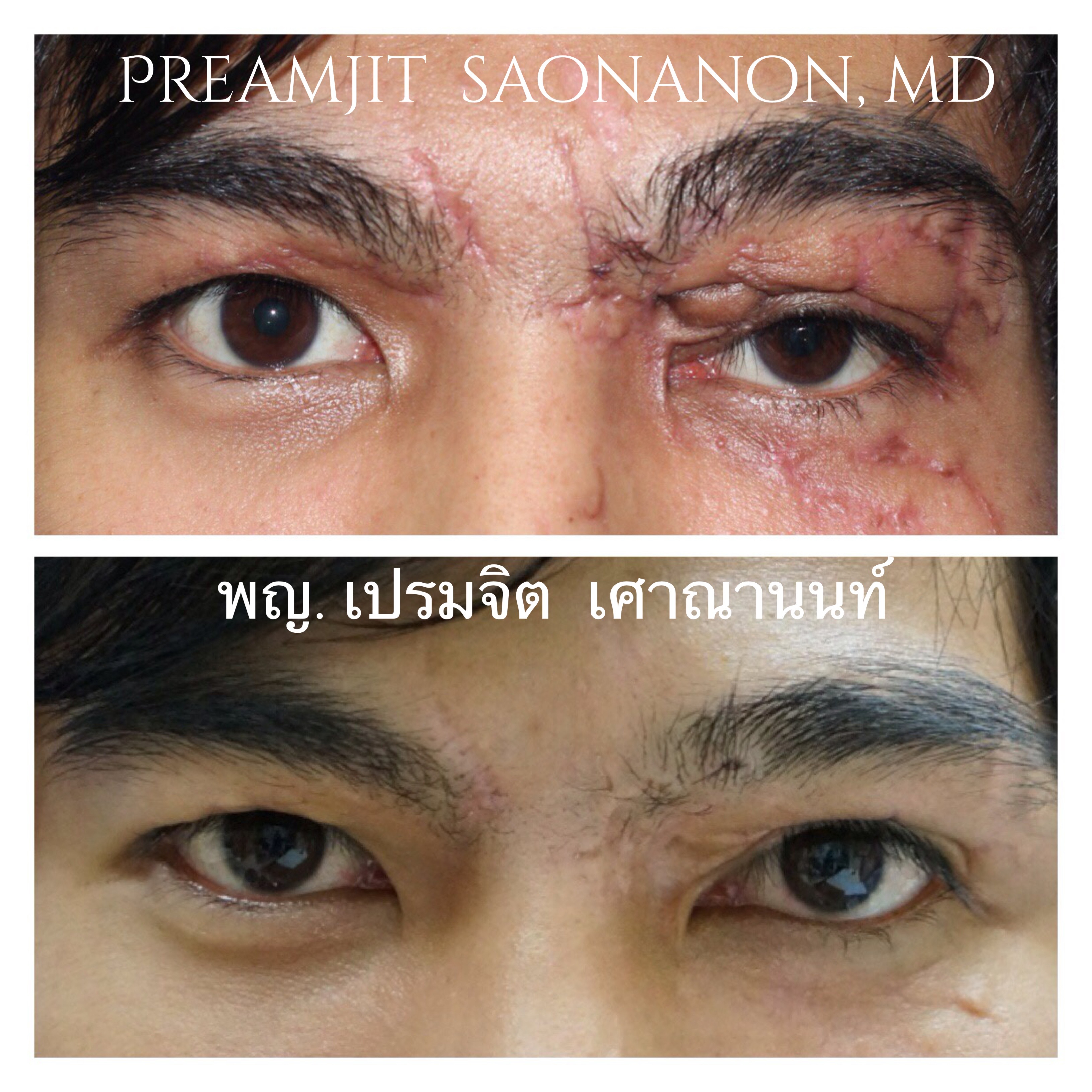 แก้ไขหนังตาตกแผลเป็น