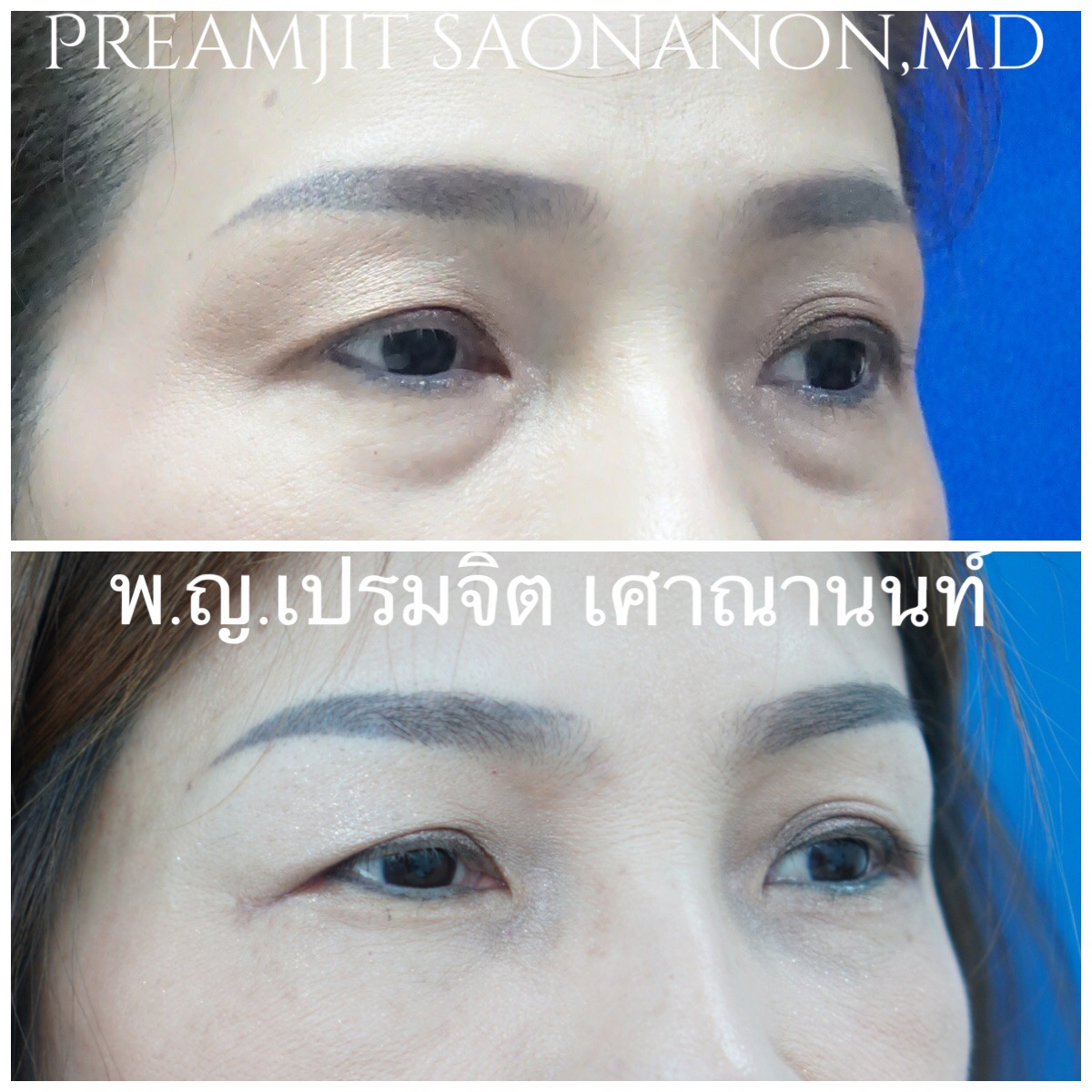 ผ่าตัดถุงใต้ตาซ้อนแผลและย้ายไขมัน