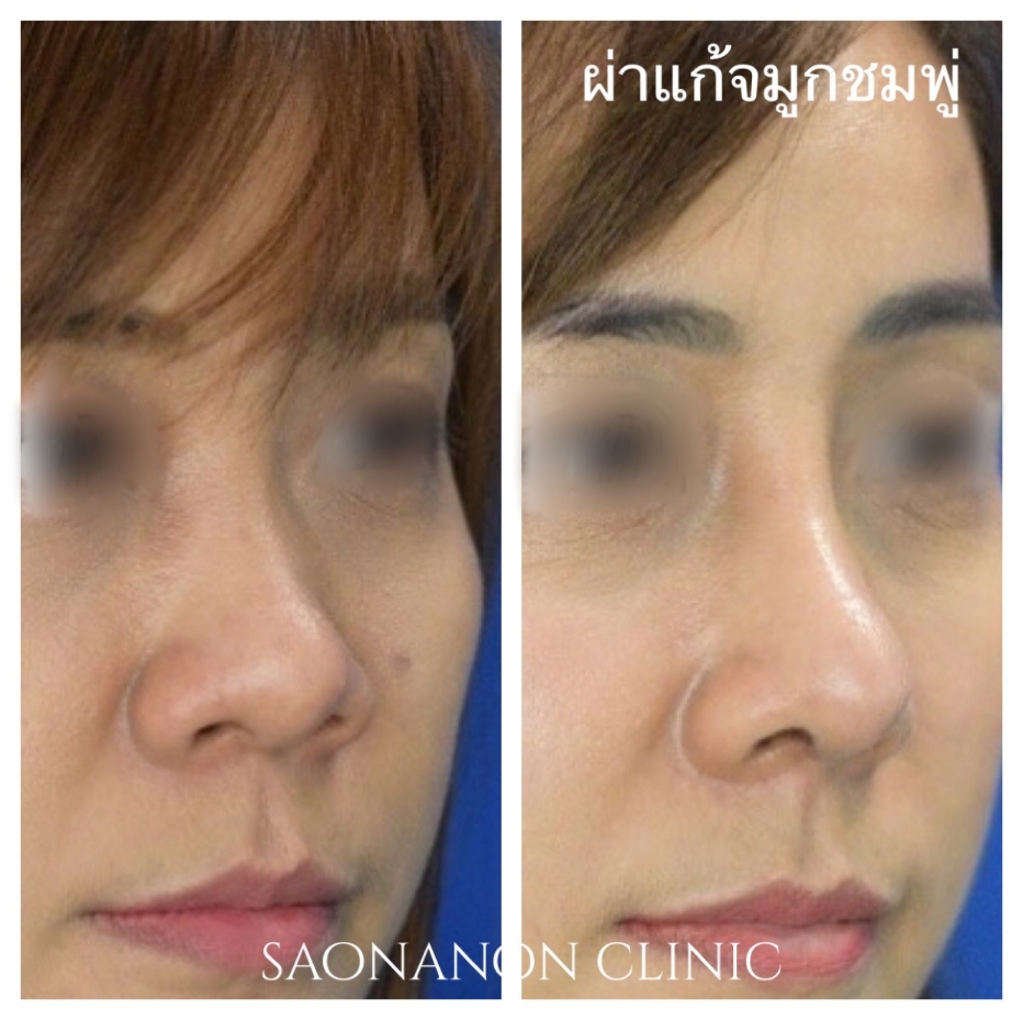 จมูกอ้วน ฐานกว้าง