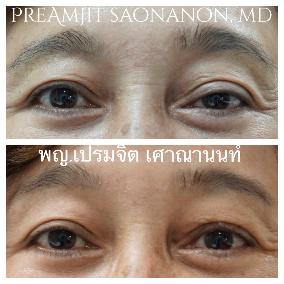 แก้ไขหนังตาตกจากการผ่าตัด