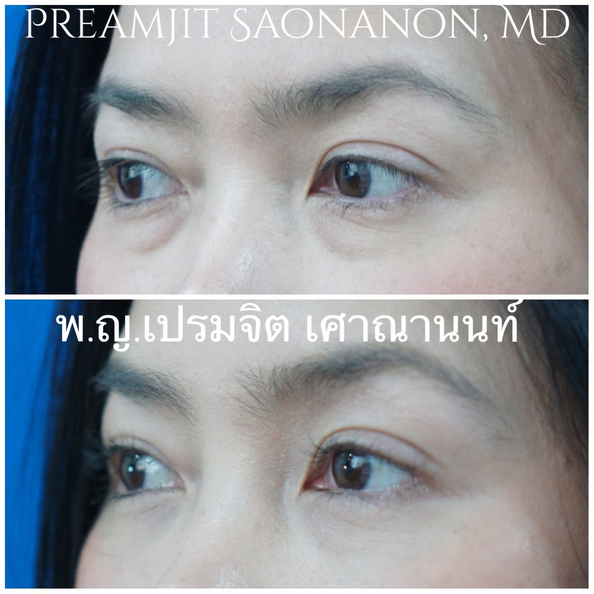 ผ่าตัดถุงใต้ตา ย้ายไขมัน