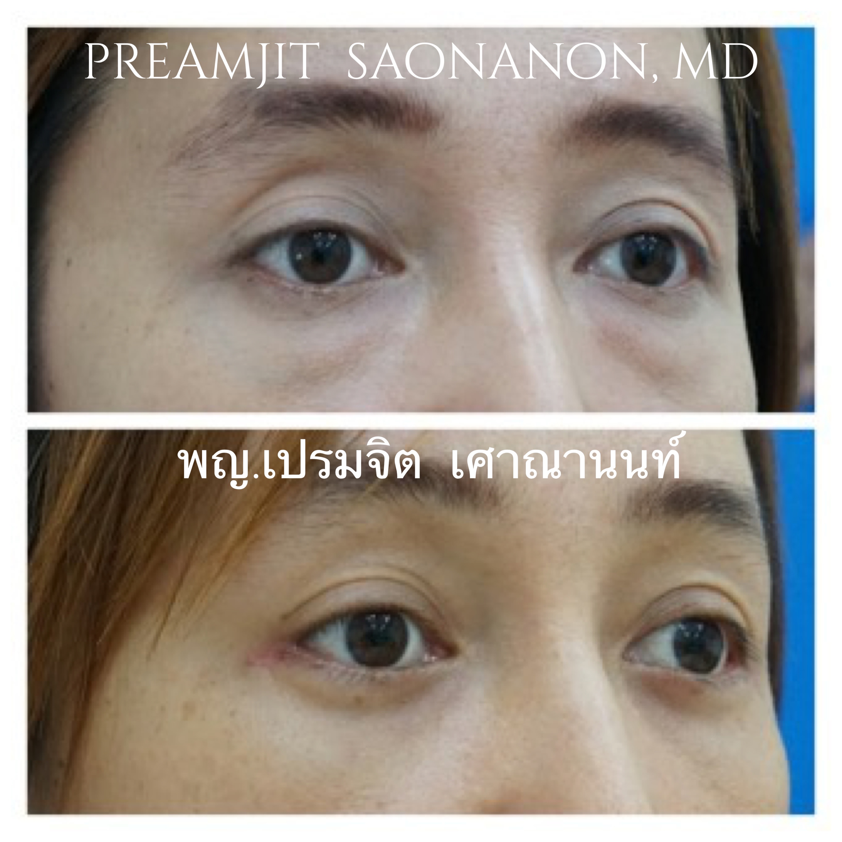 ผ่าตัดถุงใต้ตา