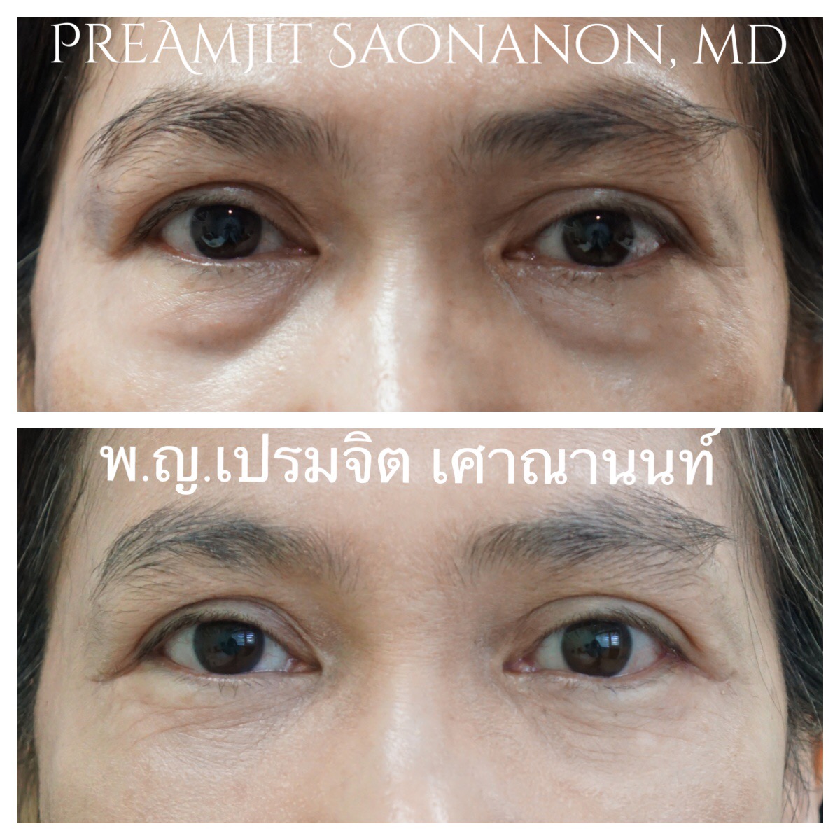 ผ่าตัดถุงใต้ตาและฉีดเติมไขมันที่ร่องแก้ม