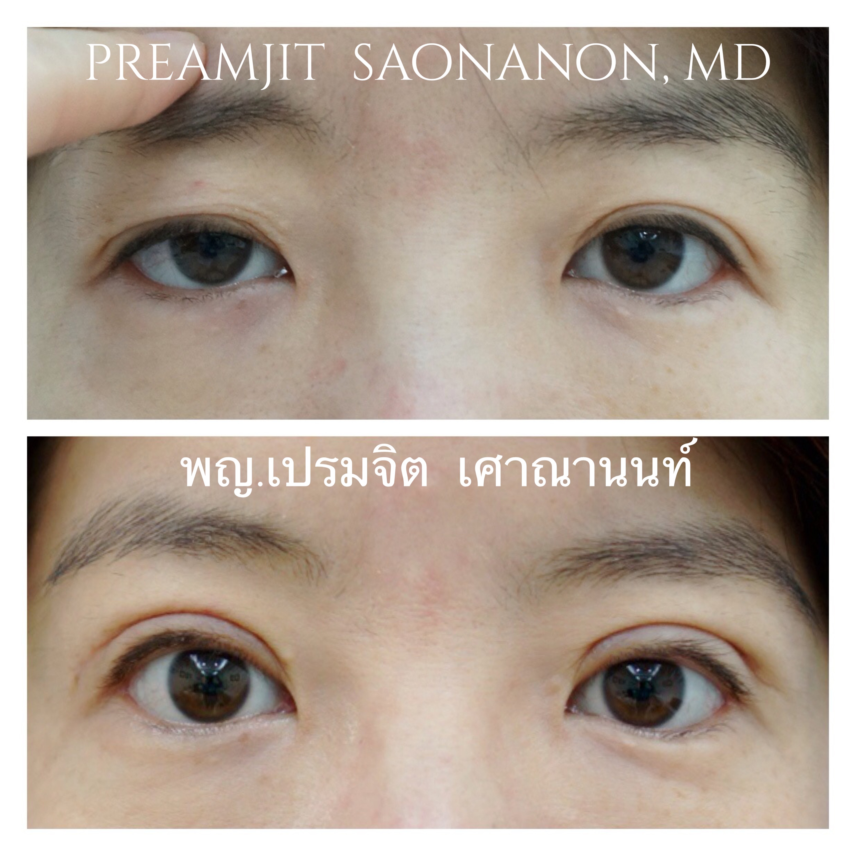 หนังตาตกหนึ่งข้าง