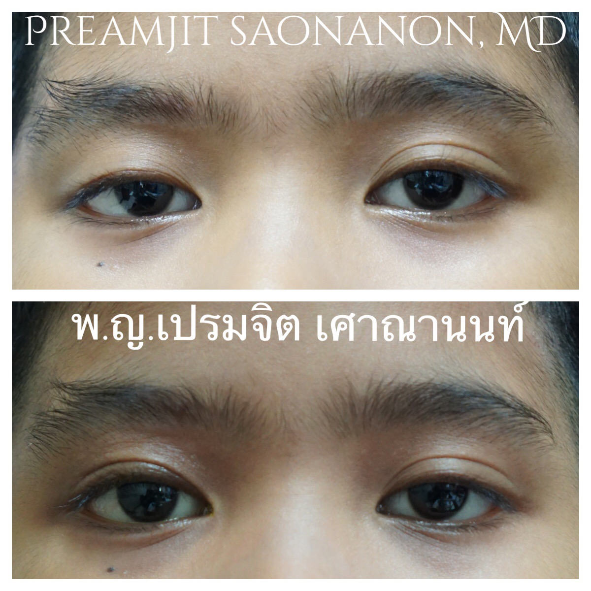 หนังตาตกแต่กำเนิดตาขวา