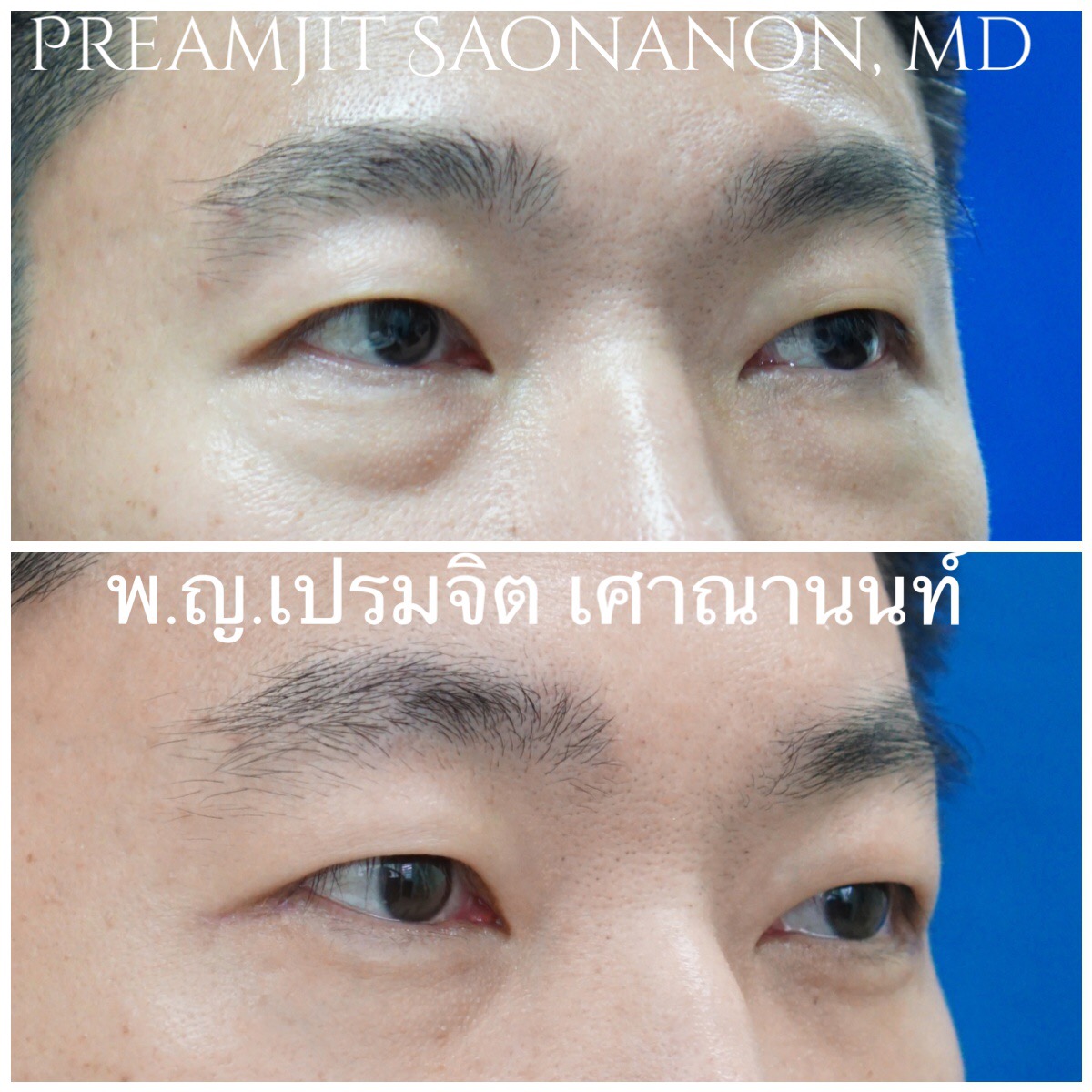 ผ่าตัดถุงใต้ตาในผู้ชาย