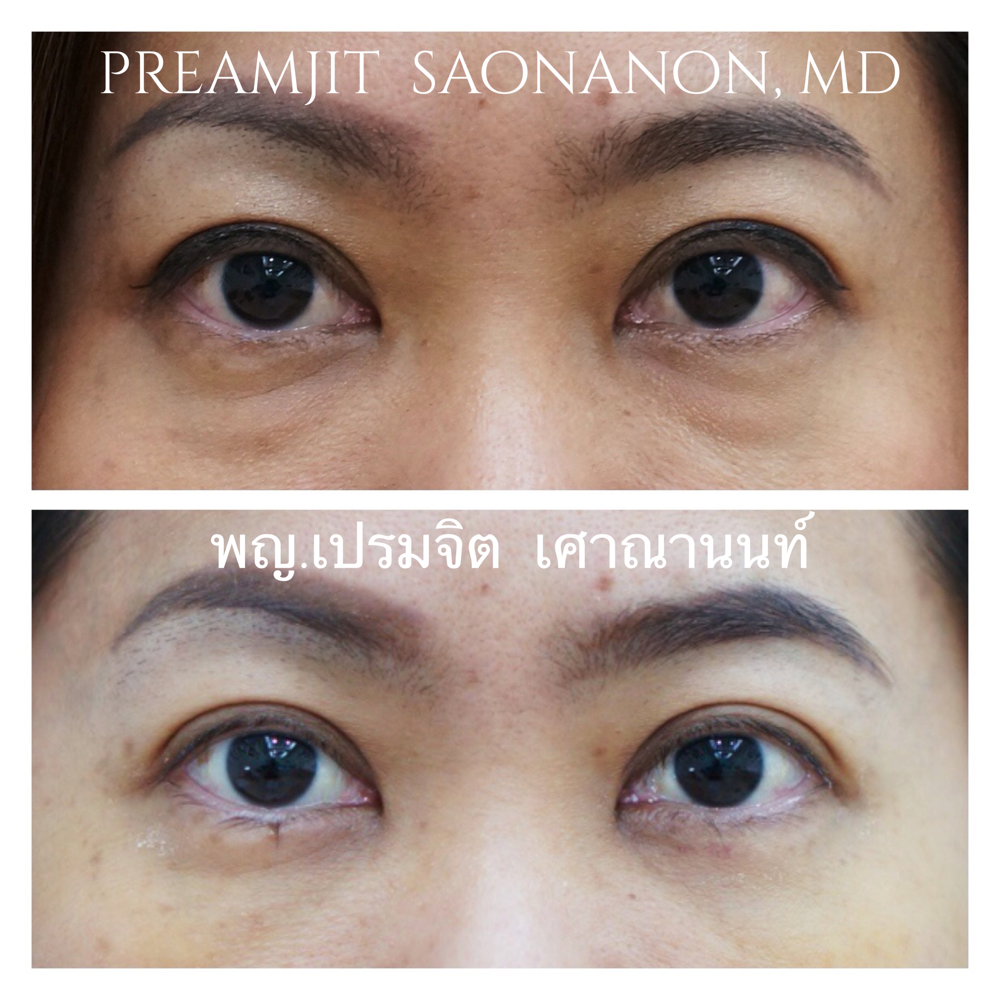 ผ่าตัดถุงใต้ตา