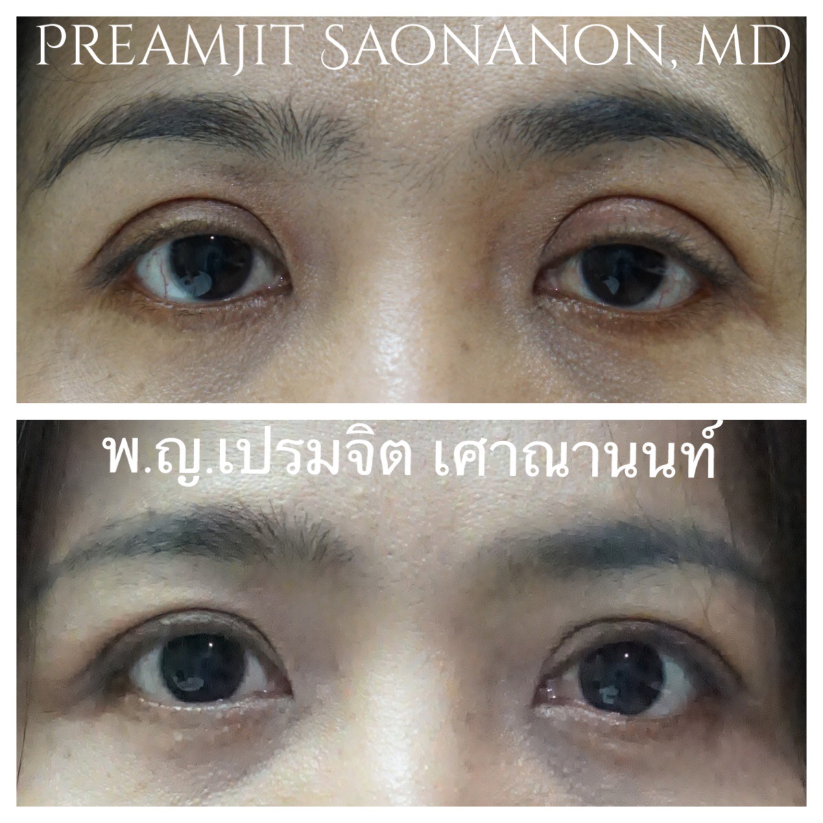 แก้ไขชั้นตาสูงจากการผ่าตัด