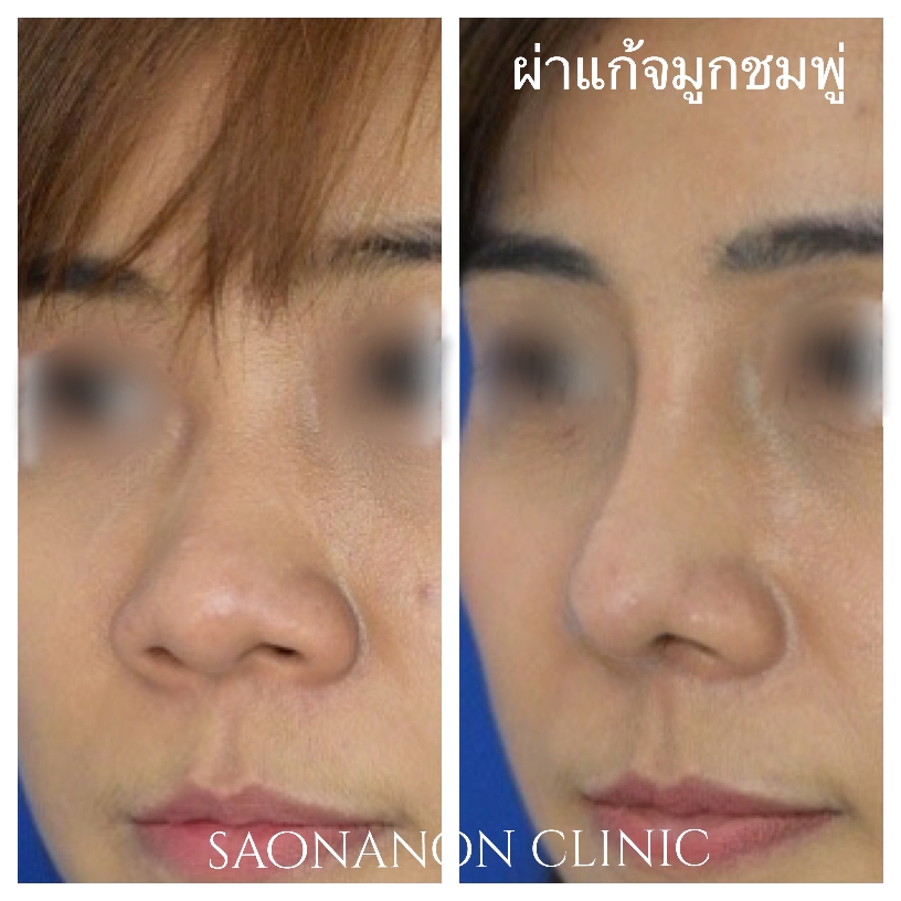 จมูกอ้วนปลายใหญ่