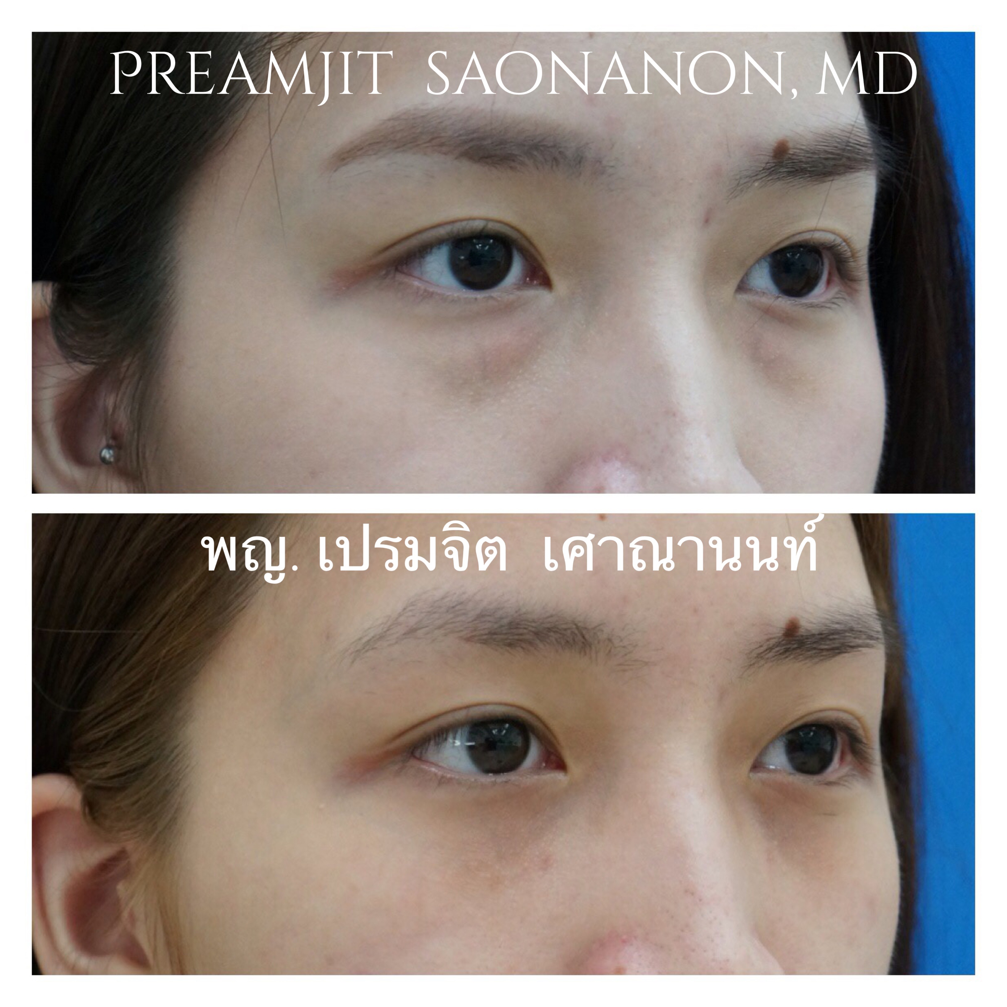 แก้ไขถุงใต้ตา