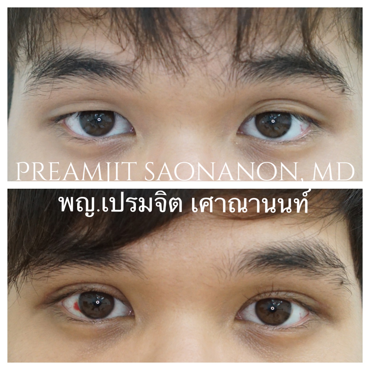 ตาสองชั้นในผู้ชาย