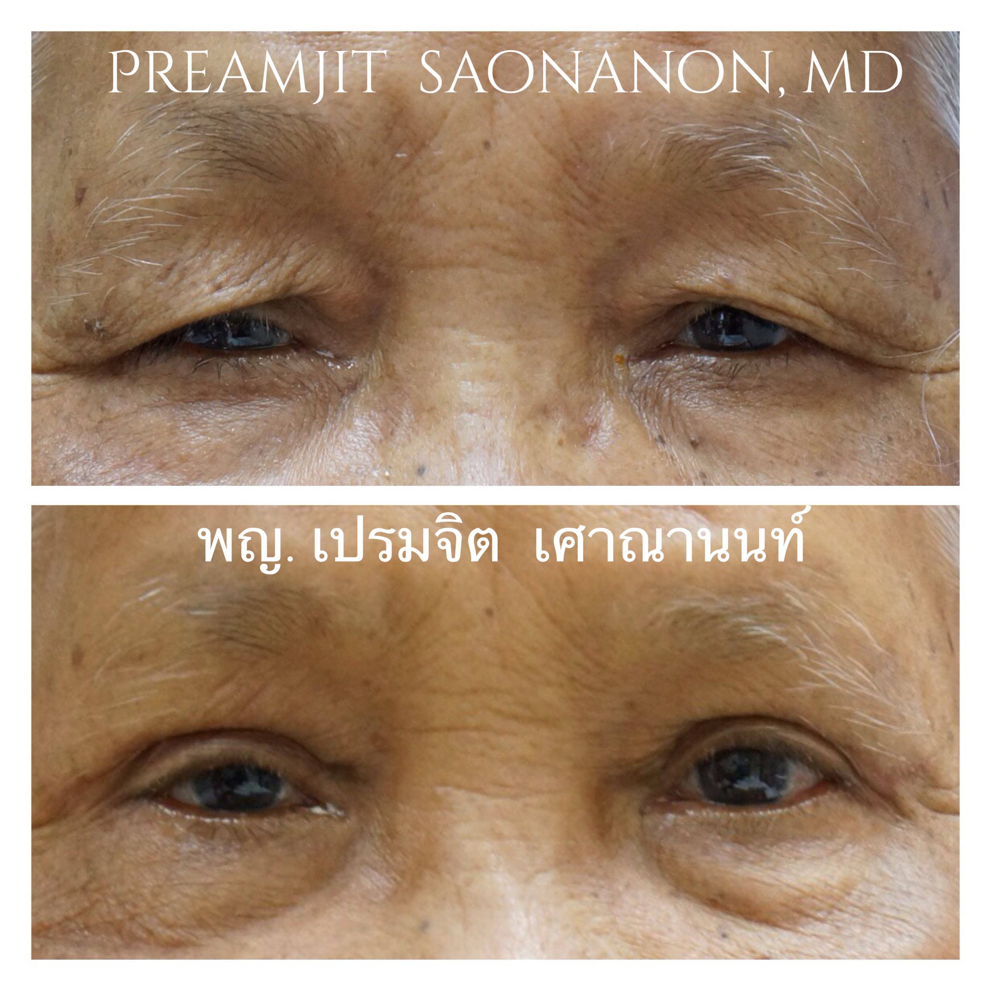 ผ่าตัดหนังเกินดึงกล้ามเนื้อตา