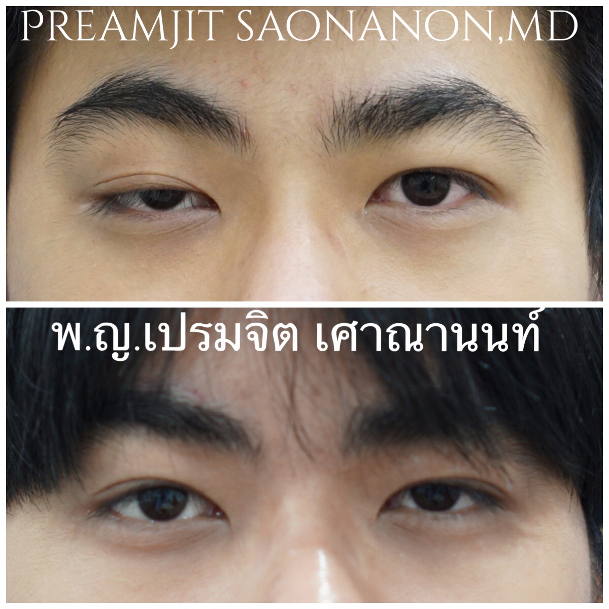 หนังตาตกแต่กำเนิดตาขวา