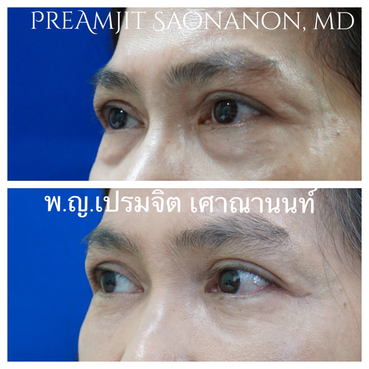 ผ่าตัดถุงใต้ตาและฉีดเติมไขมันที่ร่องแก้ม