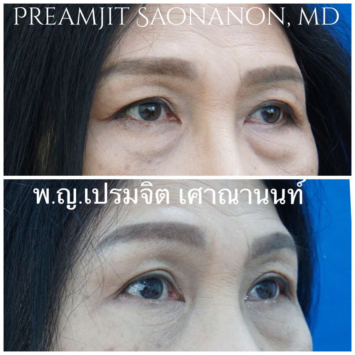 ผ่าตัดถุงใต้ตากรณีถุงใต้ตาใหญ่
