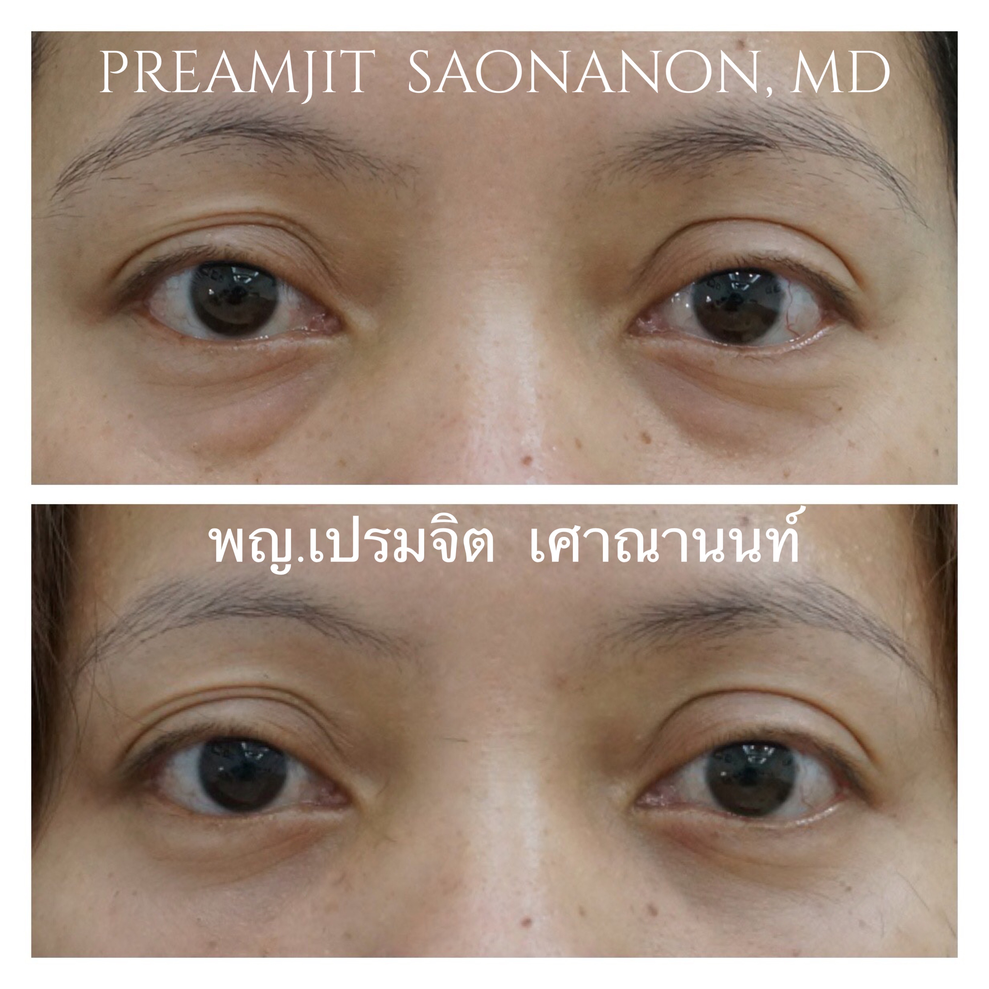 ผ่าตัดถุงใต้ตา
