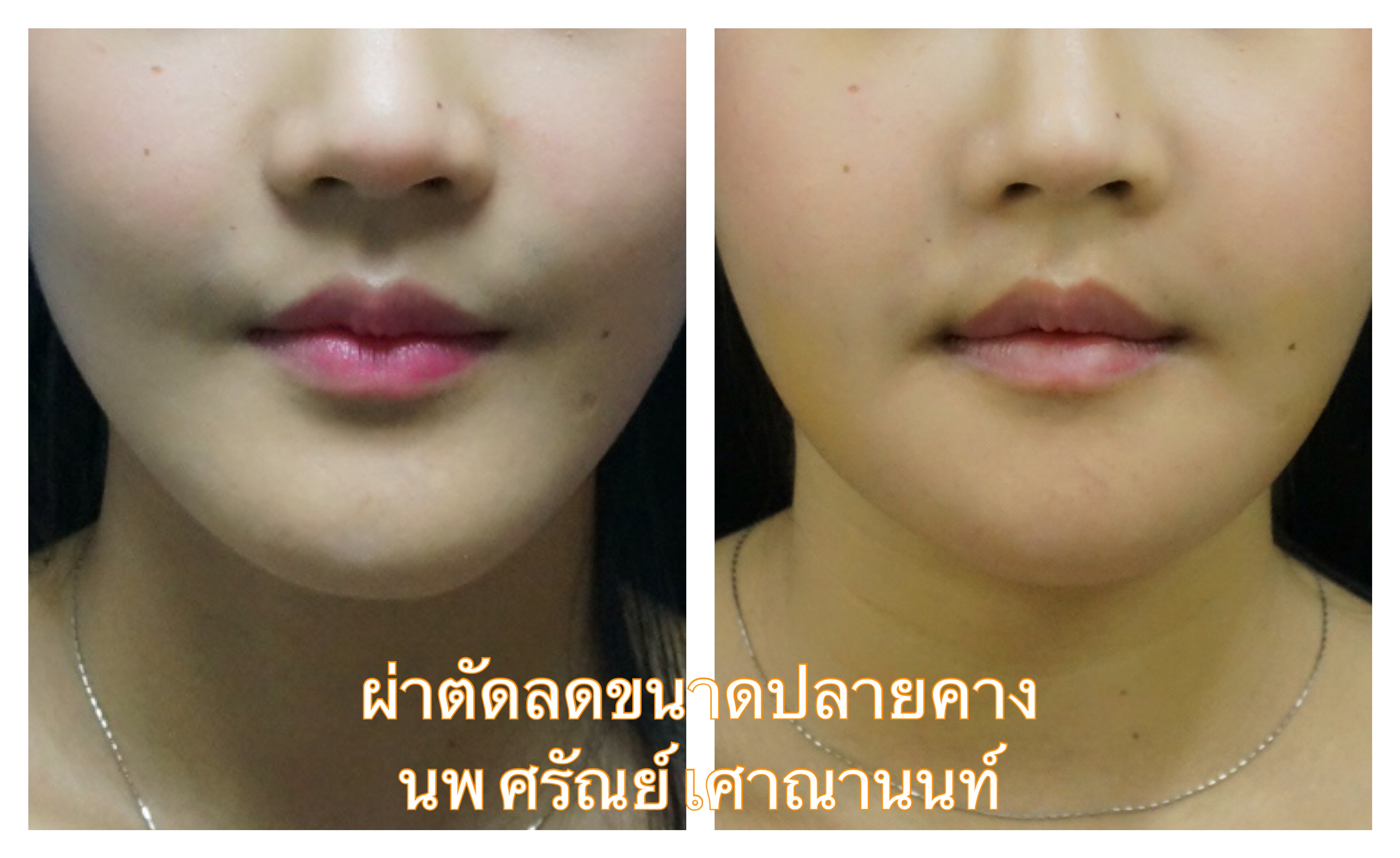 ผ่าตัดคางเรียว