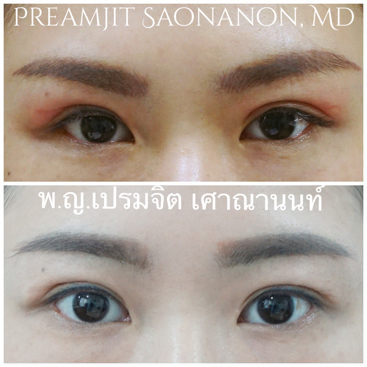 ผ่าตัดแก้ไขตาสองชั้น