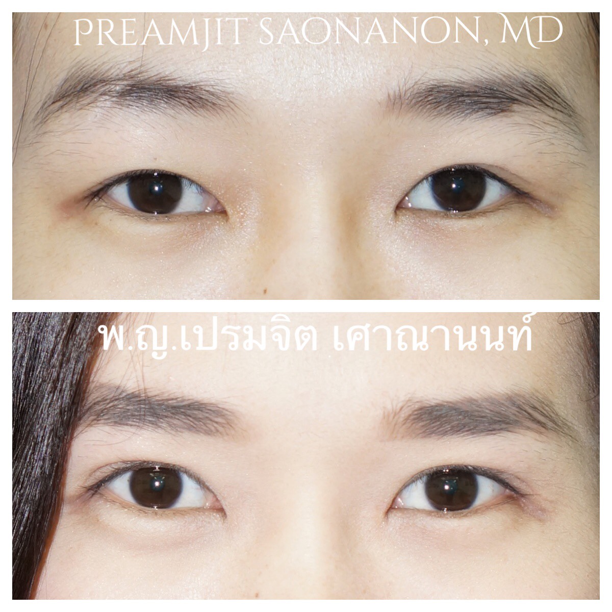 แก้ไขตาสองชั้น