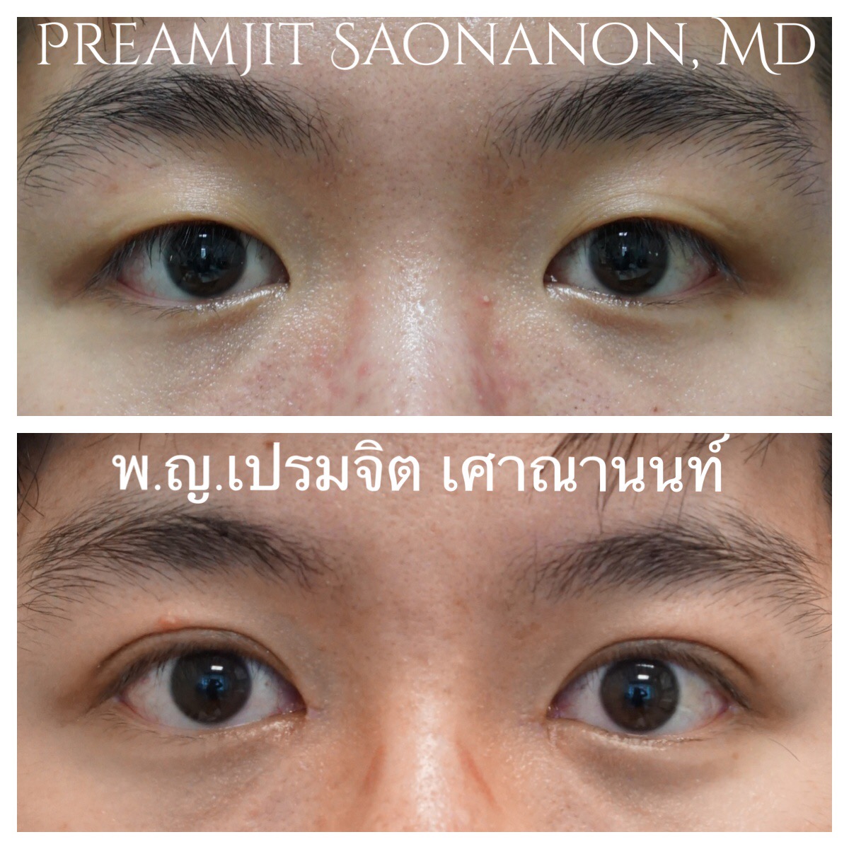 ผ่าตัดตาสองชั้นเปิดหัวตา