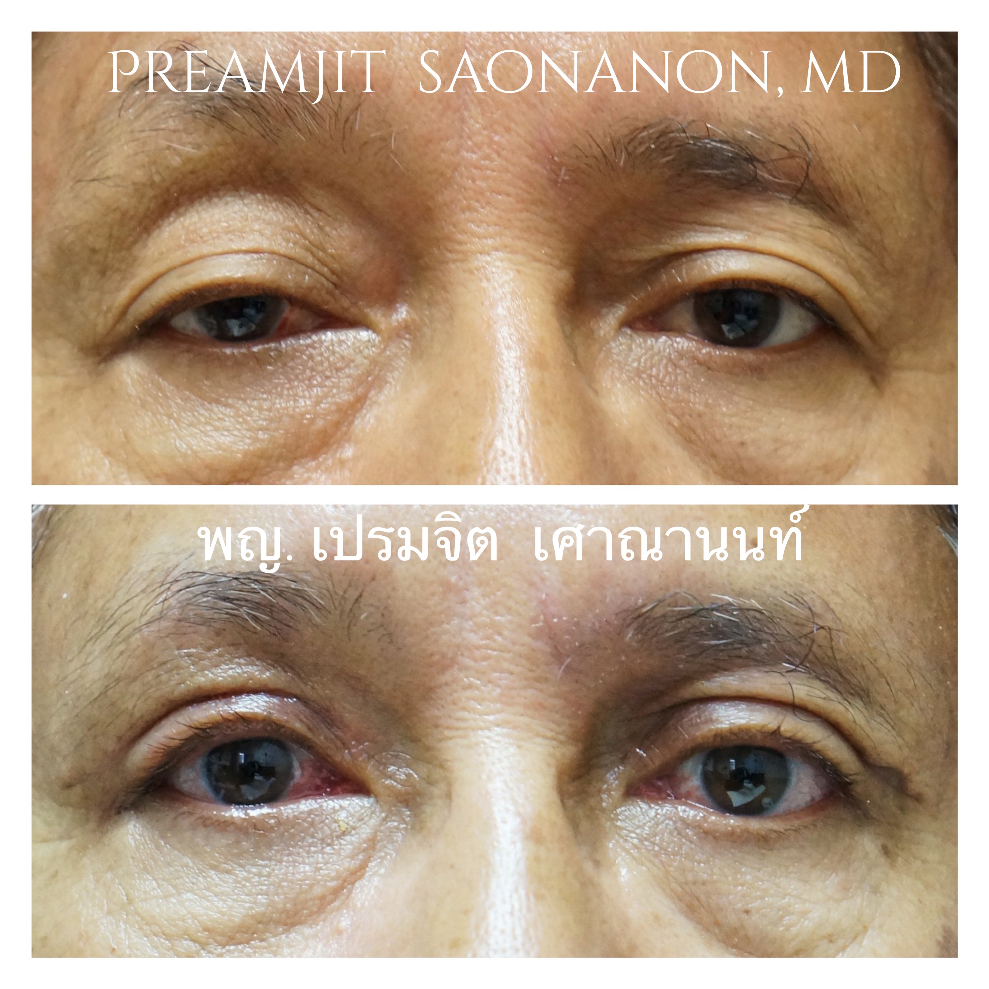 ดึงกล้ามเนือตา แต่งหนังตา