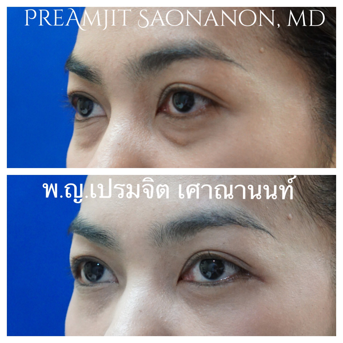 ผ่าตัดถุงใต้ตาทางเยื่อบุตาและย้ายไขมัน