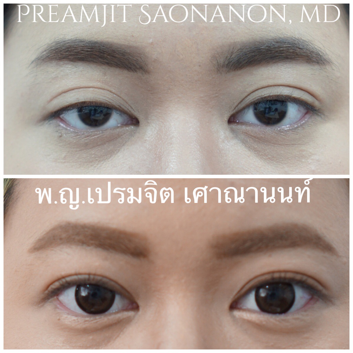หนังตาตกแต่กำเนิดสองข้าง