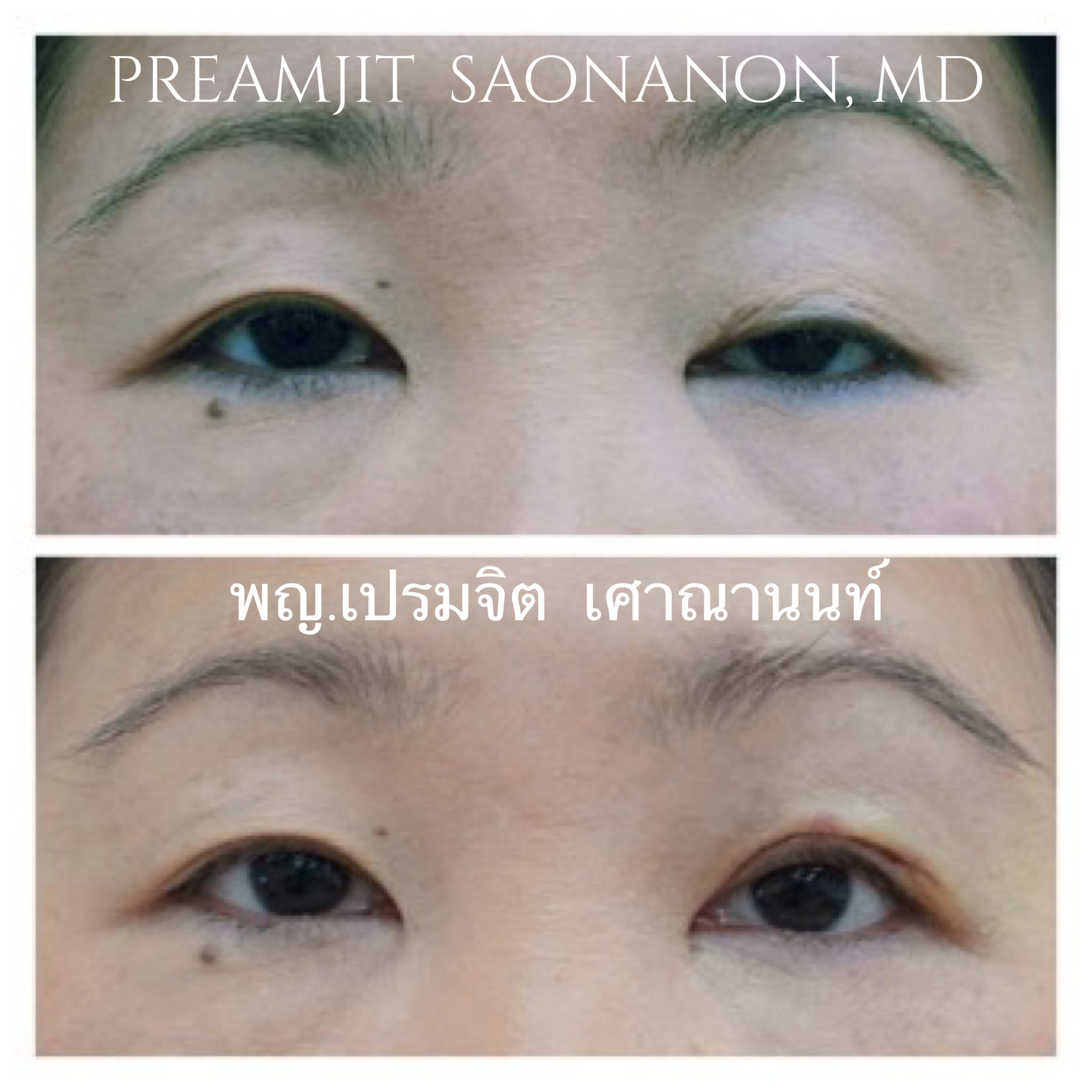 ดึงกล้ามเนื้อตา หนึ่งข้าง