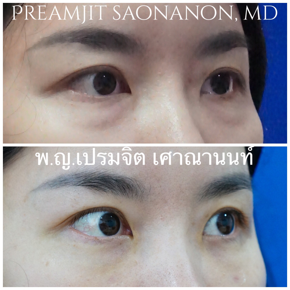 ผ่าตัดถุงใต้ตาทางเยื่อบุตาและย้ายไขมัน