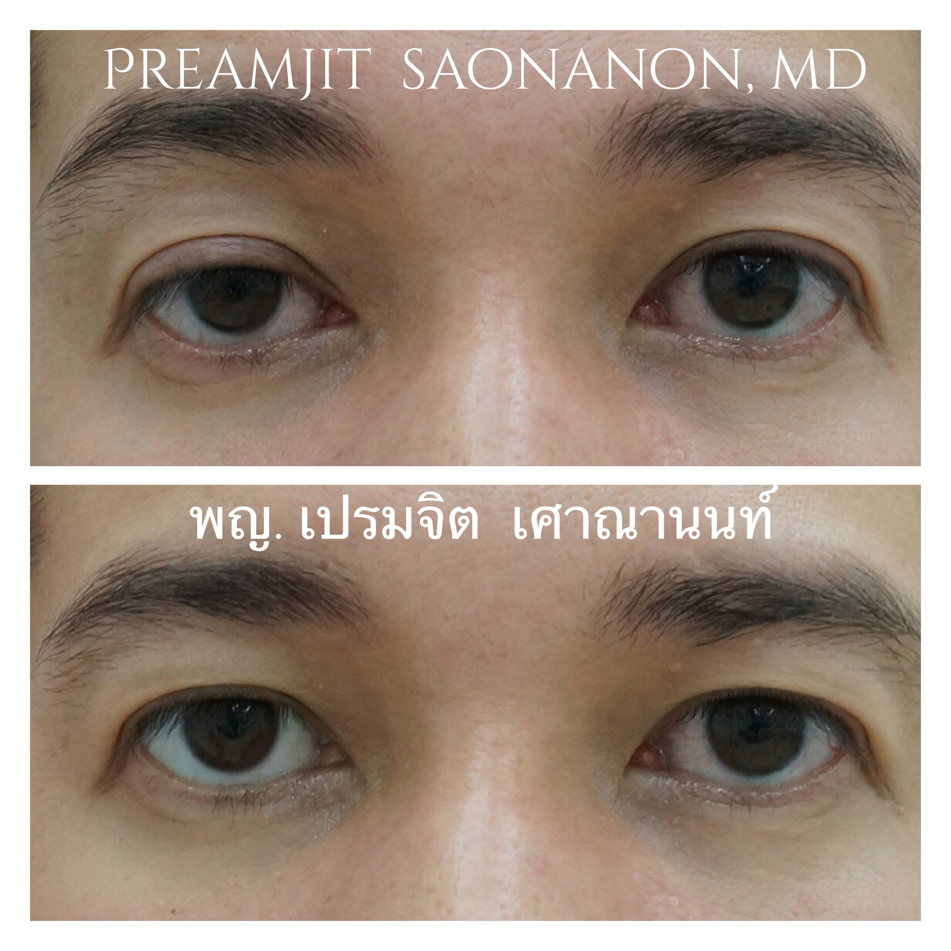 แก้ไขหนังตาตกหนึ่งข้าง