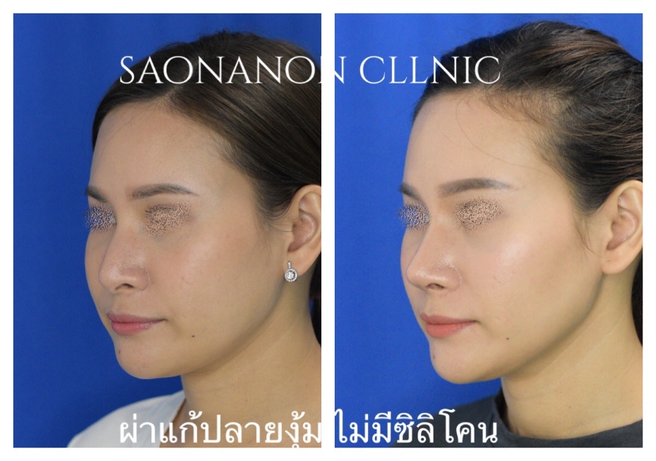 จมูกงุ้มใหญ่
