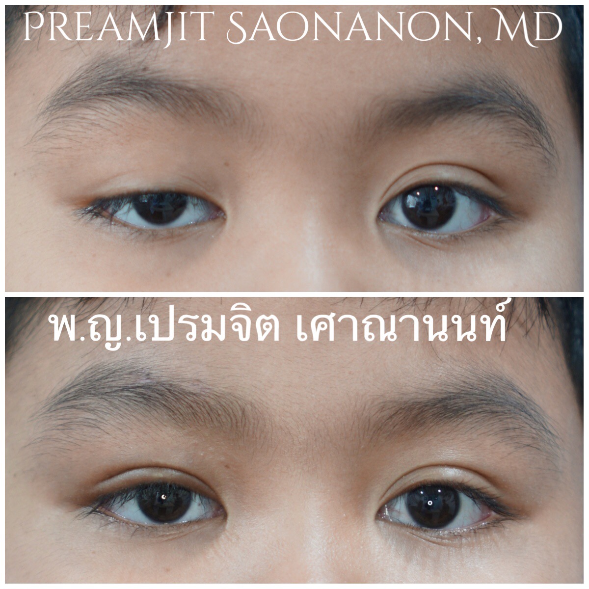 หนังตาตกแต่กำเนิดตาขวา