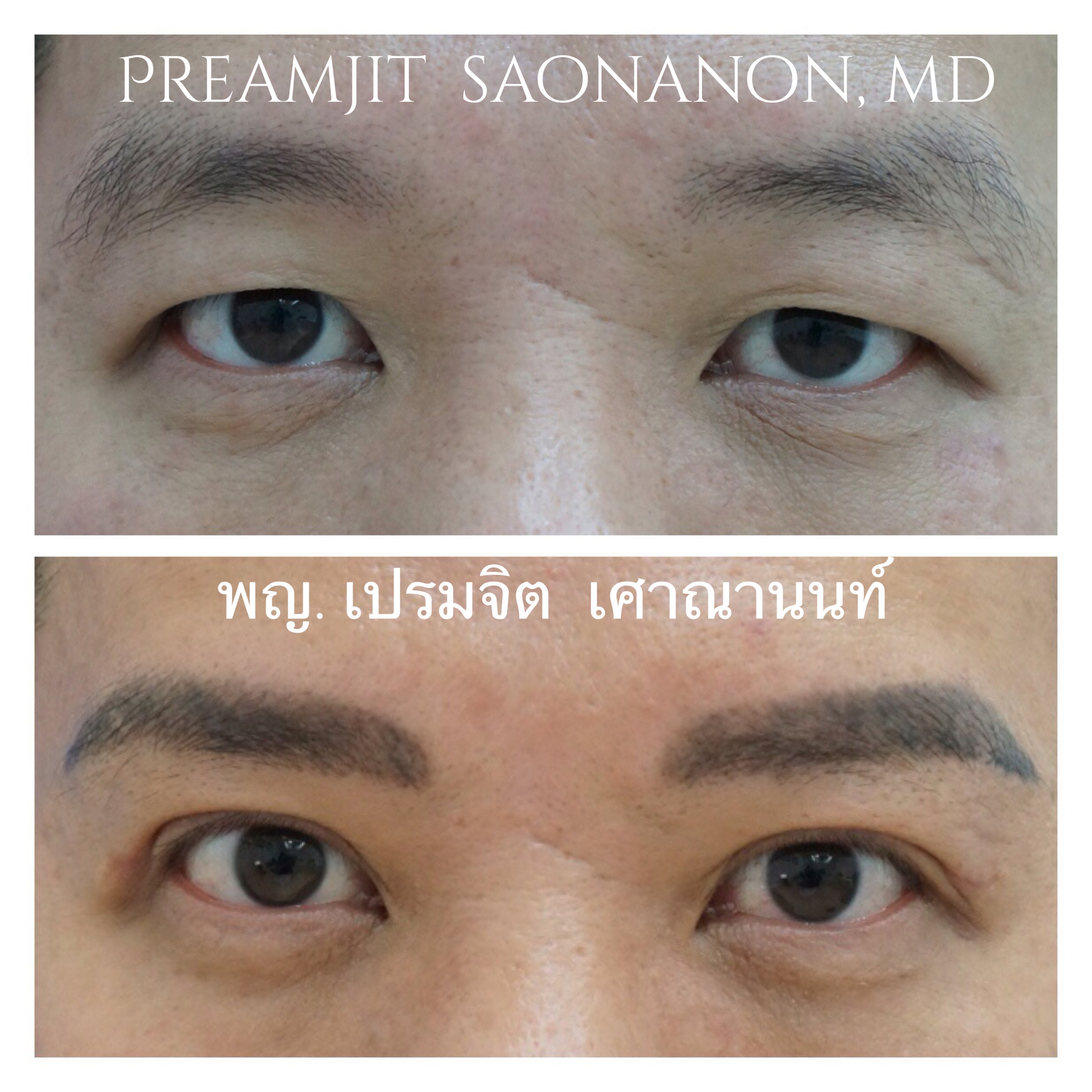 ทำตาสองชั้นแก้หนังเกิน