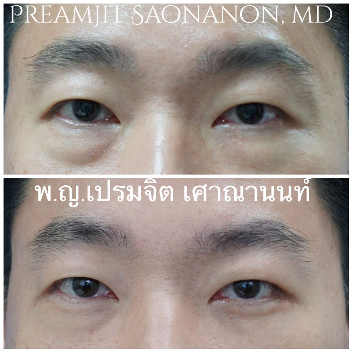ผ่าตัดถุงใต้ตาในผู้ชาย