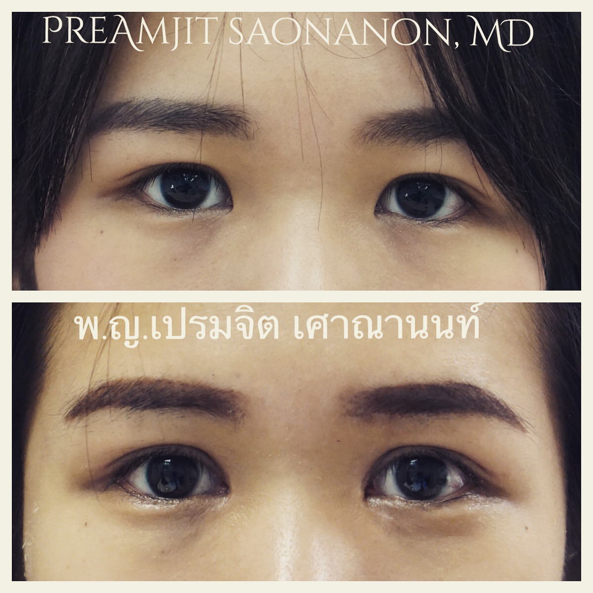 ทำตาสองชั้นเปิดหัวตา