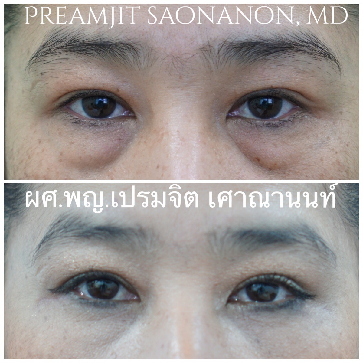 ผ่าตัดถุงใต้ตาและย้ายไขมันใต้ตา