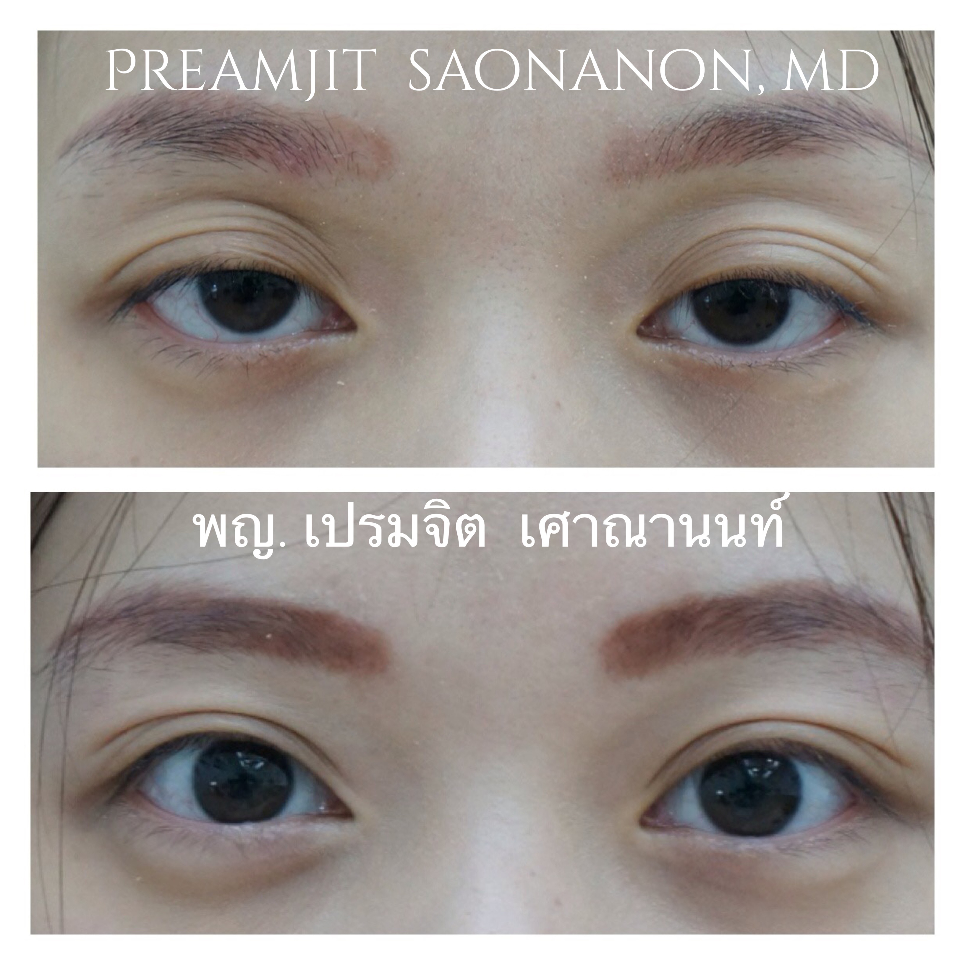 แก้ตาปรือ ดูอ่อนล้า