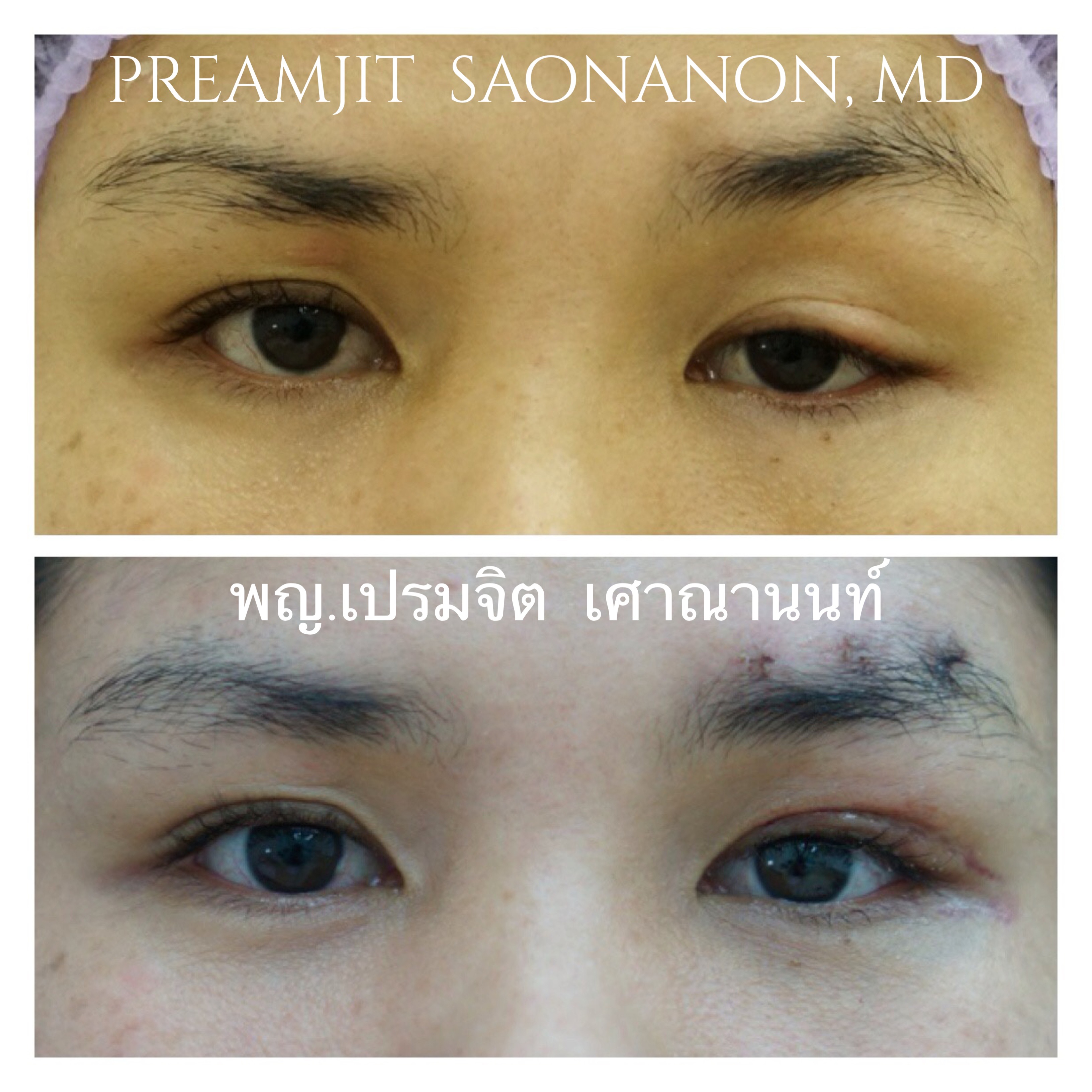 แก้ไขตาซ้าย สลิงกับคิ้ว